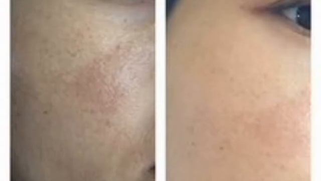 Красивая кожа это не роскошь! Результат на лицо. смотреть онлайн