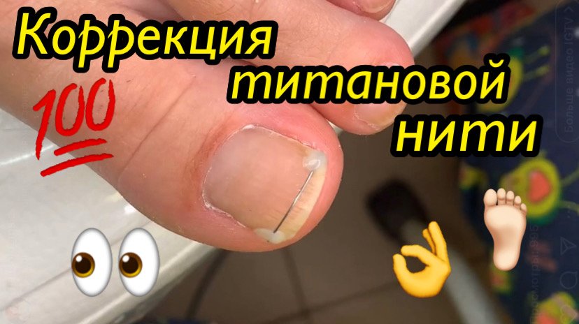Коррекция титановой нити ???? смотреть онлайн