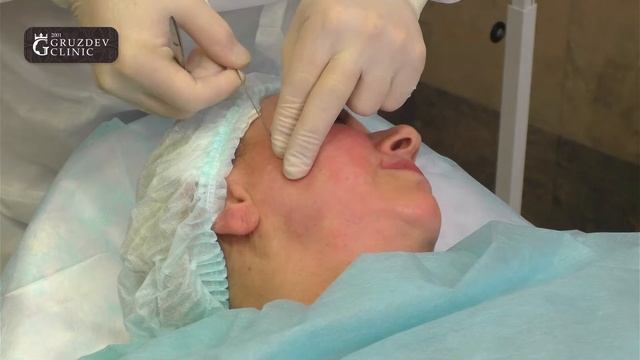 Нитевой лифтинг смотреть онлайн