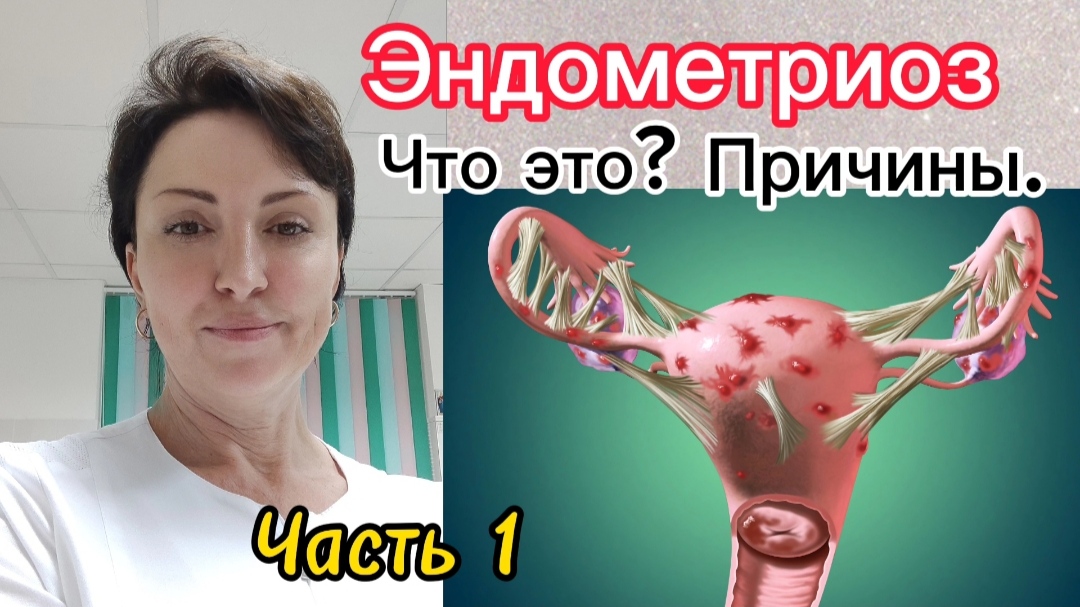 Эндометриоз. Что это? Причины. (ЧАСТЬ 1)