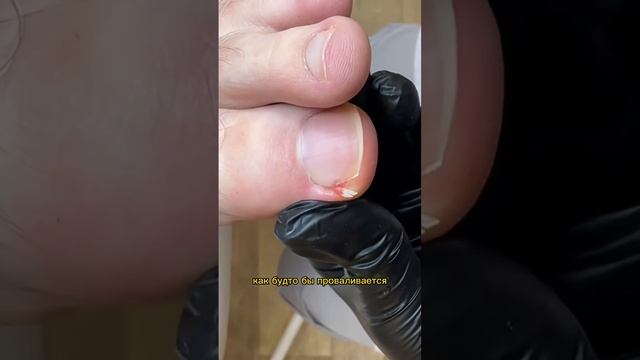 Новообразование под ногтем смотреть онлайн