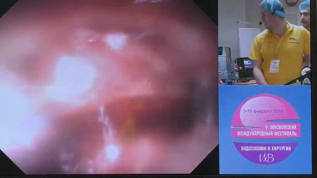 29 Live Мальков ВА Подслизистая опухоль желудка Эндоскопическая Полнослойная резекция OVESCO Aohua