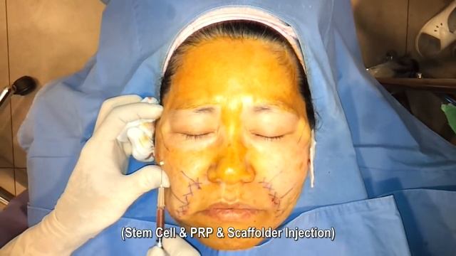 thread lifting, scaffold lifting, 녹는실리프팅, PDO 리프팅 смотреть онлайн