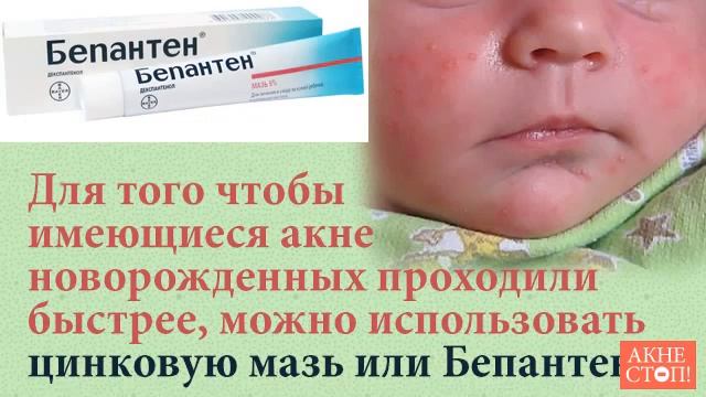 Акне новорожденного или что делать с прыщиками смотреть онлайн