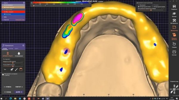 моделировка окклюзионно-стабилизирующей каппы в exo cad
