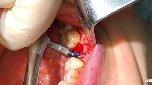 Удаление зуба 3.6 с одномоментной дентальной имплантацией. Профессор Орлов А.А. смотреть онлайн