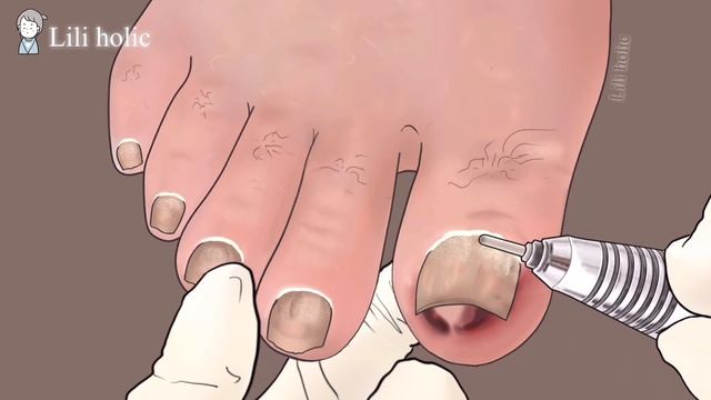 Satisfying Ingrown Toenail Removal Treatment Animation