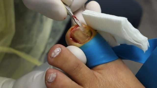 THE FASTEST WAY TO TREAT TOENAIL FUNGUS?! смотреть онлайн