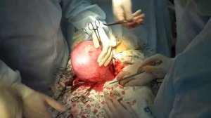 Ампутація матки