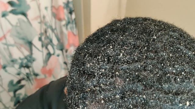 Flakeomania? | Dandruff Scratching смотреть онлайн