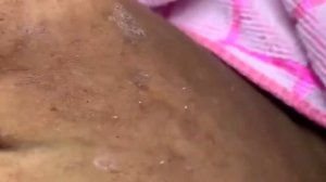 #8 Прыщи, гнойники, угри, жировики, классное выдавливание!!!