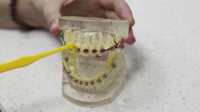 Как правильно ухаживать за зубами с брекет-системой