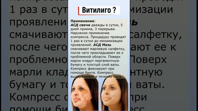 ВИТИЛИГО. Лечение с фракцией АСД-2 смотреть онлайн