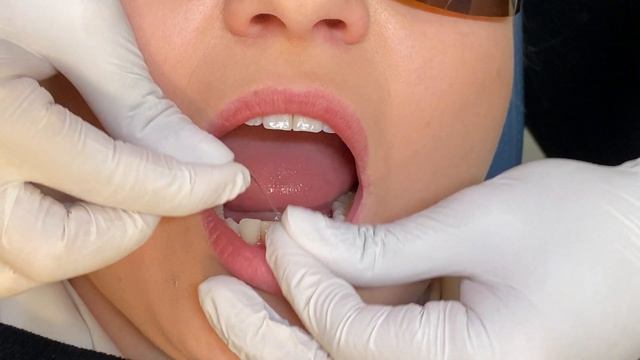 IPR for Invisalign смотреть онлайн