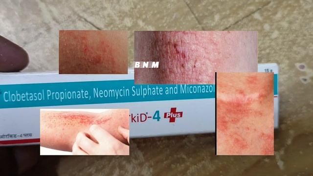 Orkid - 4 Cream uses in hindi ( पुराने से पुराने दाद ,खाज और खुजली ठीक करे ) #orkid #4 #cream смотреть онлайн