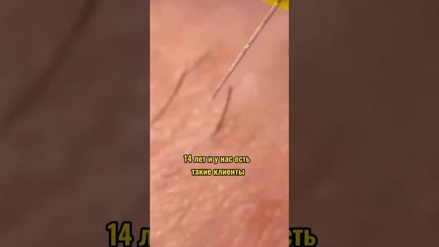 Со скольки лет можно на процедуру?? #электроэпиляция #эпиляция #лазер #сочи #epil4you #интересно смотреть онлайн