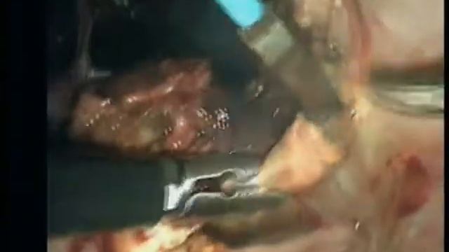 Гематома пузырно-маточного пространства. 6 сутки после КС. смотреть онлайн