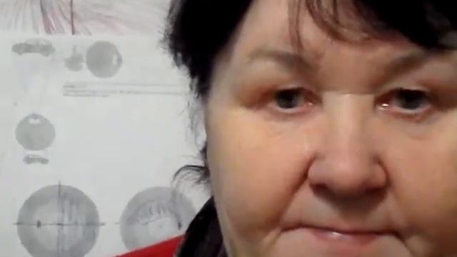 Спонтанно разрешившаяся правосторонняя межъядерная офтальмоплегия. смотреть онлайн