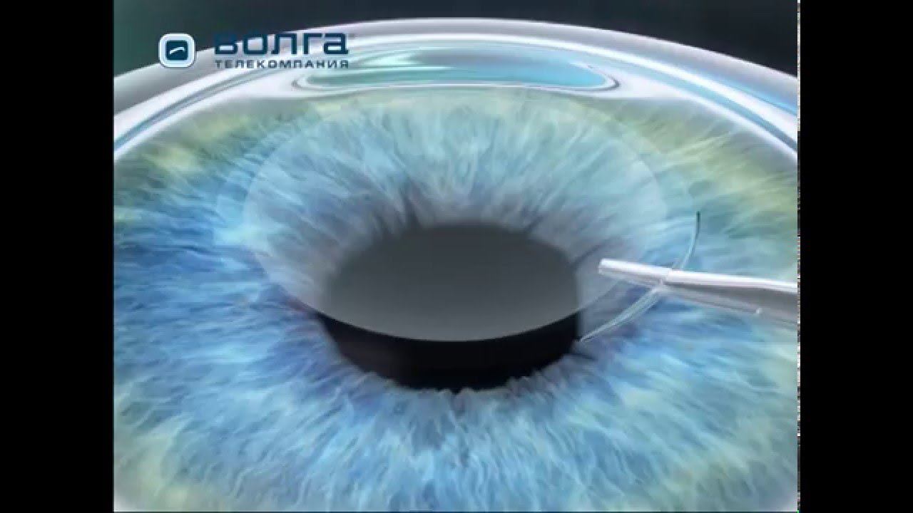 Лазерная коррекция зрения. ReLEx FLEx. ReLEx SMILE смотреть онлайн
