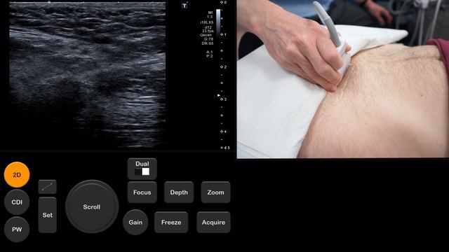 Ultrasound Tutorial: Inguinal/Femoral Hernia Assessment | Radiology Nation