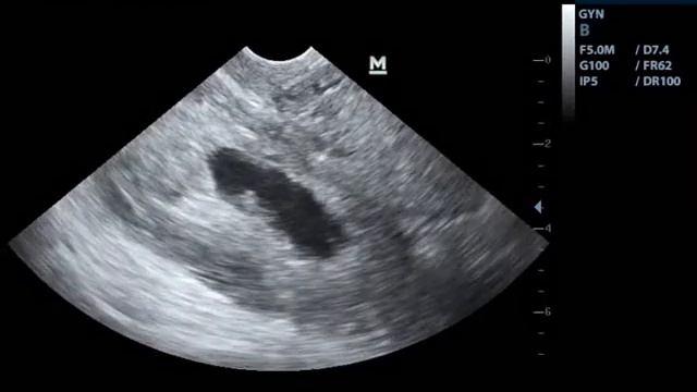 Малый таз смотреть онлайн