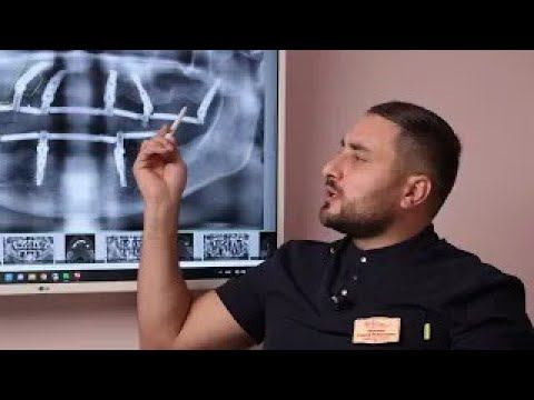 Почему для верхней челюсти лучше 6 имплантов