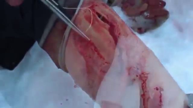 ГЕМАТОМЫ,полевое лечение смотреть онлайн