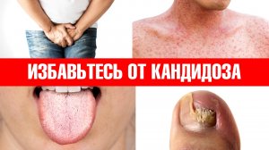 Примените эти 6 средств, и кандидоз никогда не вернется?