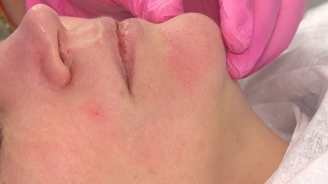 Чистка лица