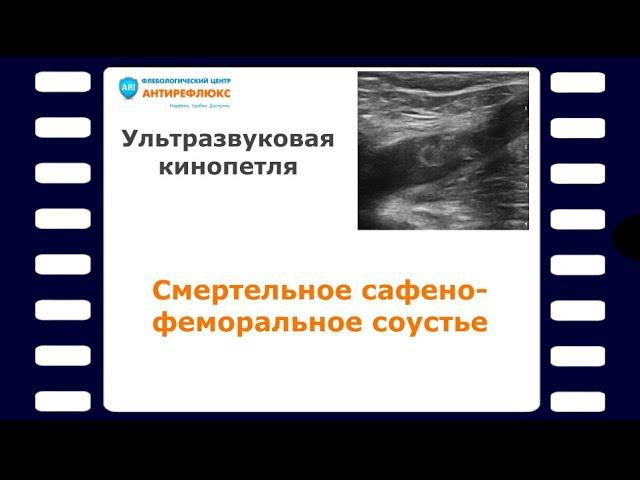 Смертельное сафено-феморальное соустье смотреть онлайн