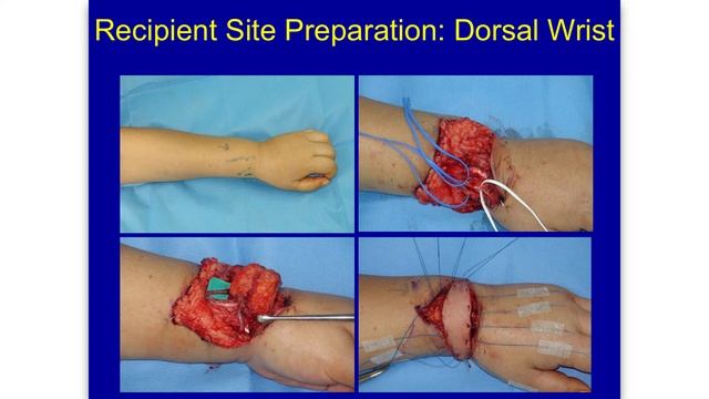 Lymph Node Transplant - Submental/Groin - Ming-Huei Cheng, MD - Harvard Symposium смотреть онлайн