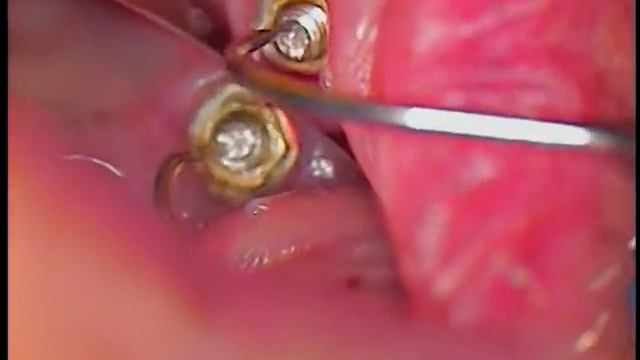 3. Dental Implant broken screw case - Branemark Estheticone abutments and screws retrieved смотреть онлайн