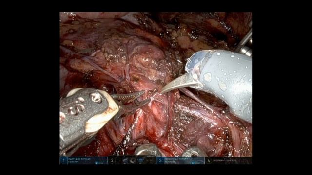 Robotic assisted bilateral nerve sparing retroperitoneal lymph node dissection without repositionin смотреть онлайн
