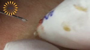 Clean Giant Blackheads on Nose