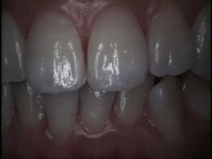 металлокерамика 1 часть  для зубных техников