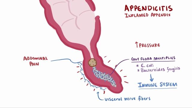 Appendicitis | Clinical Presentation смотреть онлайн