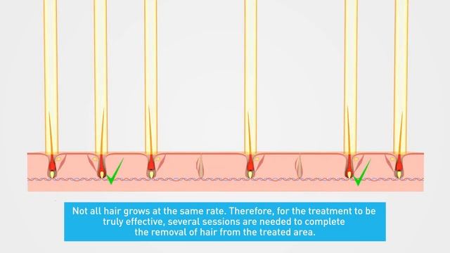Epilium Laser Hair Removal in 3D смотреть онлайн