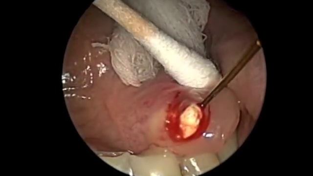 Large Salivary Gland Stone Removal Extraction Sialendoscopy смотреть онлайн