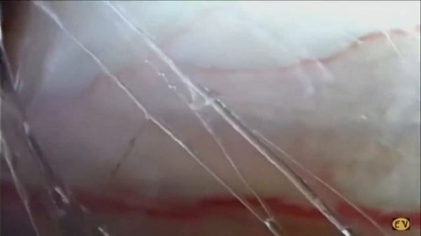 Скольжение под кожей (Strolling under the skin) Dr. Jean Claude Guimberteau