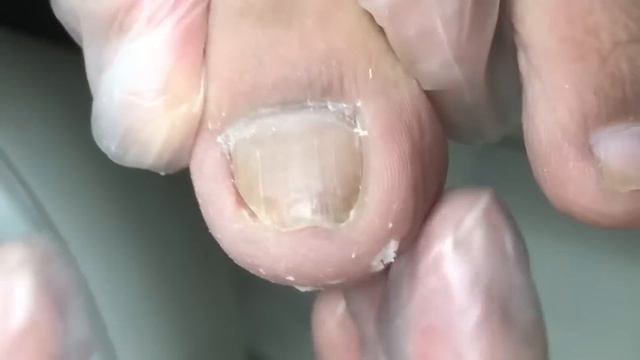 Simple repair of ingrown nails on both sides!【Crazy pedicure room】 смотреть онлайн