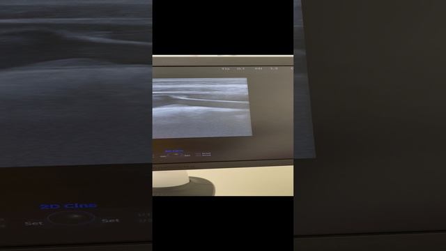 Атеросклероз сонных артерий. Узи сосудов. Высокий холестерин. Сосудистый хирург. Флеболог Москва смотреть онлайн