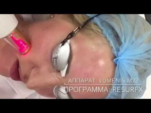 ФРАКЦИОННЫЙ ТЕРМОЛИЗ - в Клинике Градиент смотреть онлайн