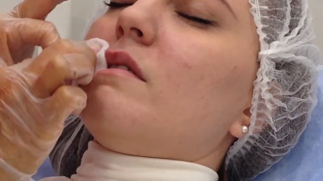 Увеличение ГУБ! Выкладываем КОНТУР губ филером в два этапа при тонких и острых формах губ.