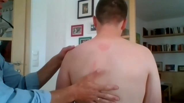 Маттиас Буркерт о дифференциальной диагностике синдрома выхода грудной апертуры (ТОS).