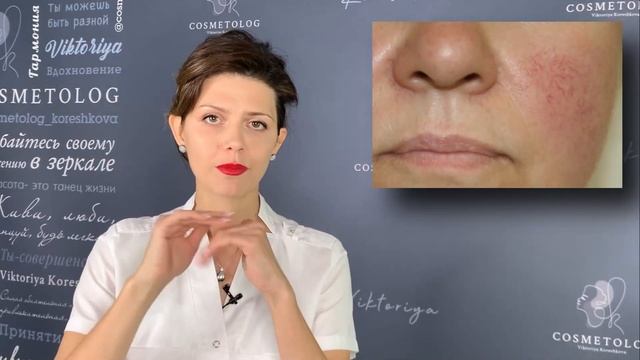 Как выбрать ПИЛИНГ ДЛЯ ЧУВСТВИТЕЛЬНОЙ КОЖИ? Пилинг при КУПЕРОЗЕ ? Косметолог отвечает на вопросы смотреть онлайн