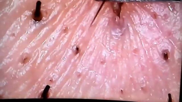 Acne Under The Microscope Чёрные точки! Вросшие волосы! Под микроскопом! Pimples! Acne