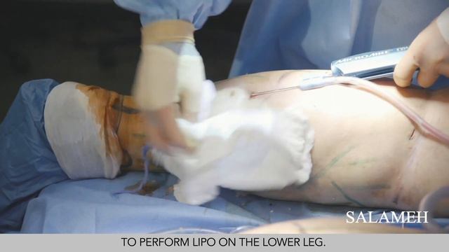 Lipedema Surgery With Liposuction Part 1 | Salameh
