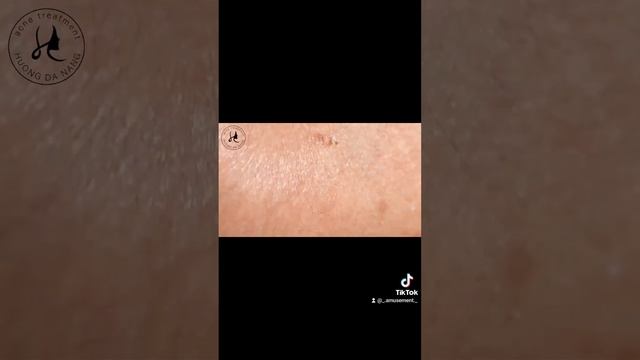 #асмр #прыщи #acnetreatment #acne #asmracne #угри смотреть онлайн