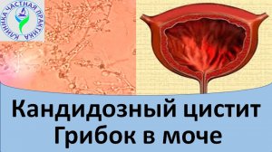 Кандидозный цистит. Грибок в моче