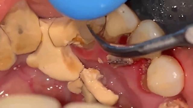 Tartar removal Get rid of hidden tartar! Tartar gush from the gums Part 1 смотреть онлайн